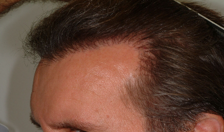 After Image: Patient # 29198 - 
