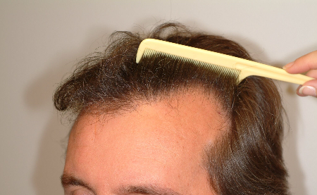 Before Image: Patient # 29198 - 