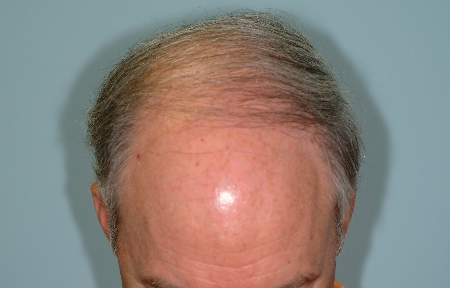 Before Image: Patient # 61157 - 