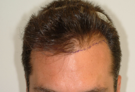Before Image: Patient # 99952 - 