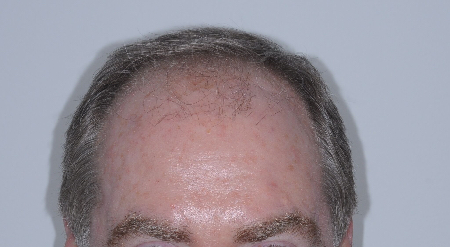 Before Image: Patient # 93615 - 