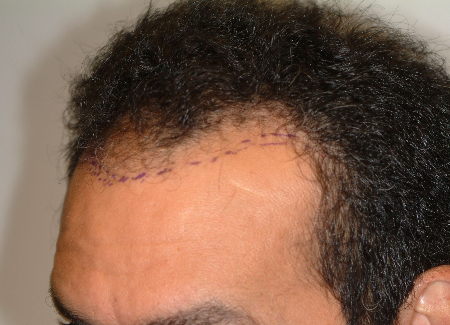 Before Image: Patient # 86050 - 