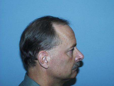 Before Image: Patient # 30624 - 