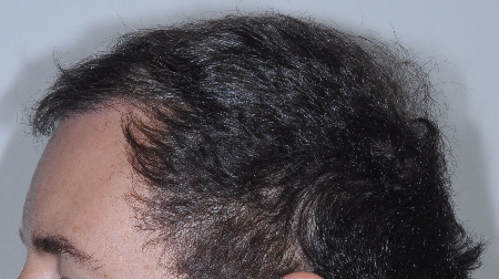 After Image: Patient # 48126 - 