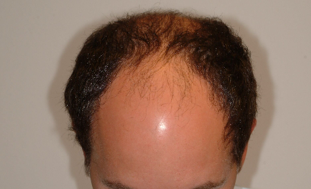 Before Image: Patient # 48126 - 