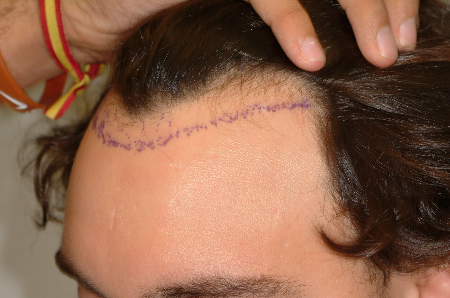 Before Image: Patient # 74721 - 