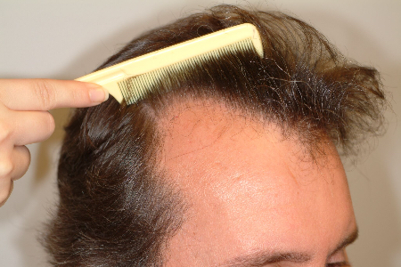 Before Image: Patient # 29198 - 
