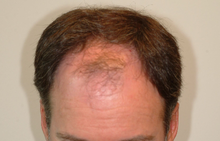 Before Image: Patient # 80968 - 