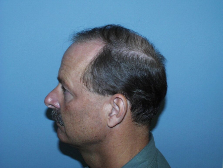 Before Image: Patient # 30624 - 