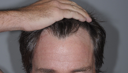 Before Image: Patient # 50904 - 