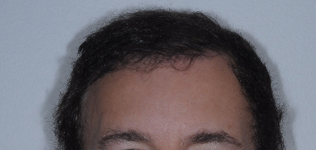 After Image: Patient # 48126 - 