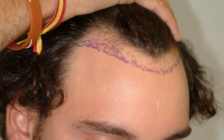 Before Image: Patient # 74721 - 