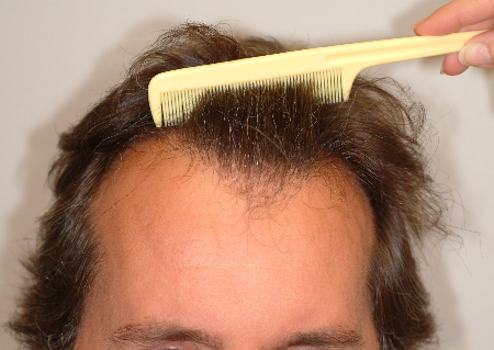 Before Image: Patient # 29198 - 