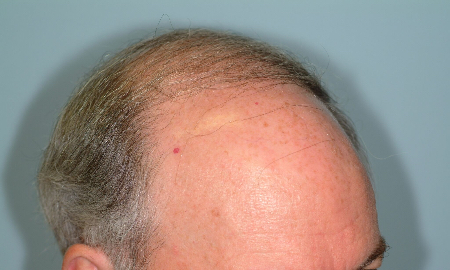 Before Image: Patient # 61157 - 