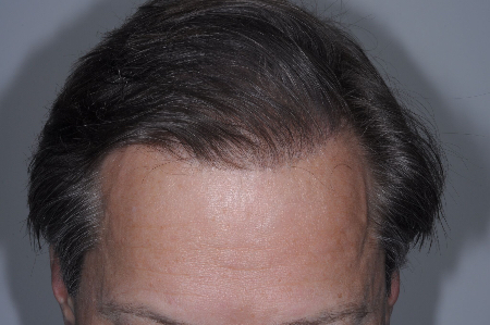 After Image: Patient # 33228 - 