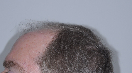 Before Image: Patient # 93615 - 