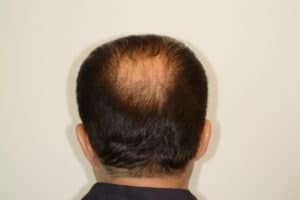 Hair Transplant Before & After | Houston TX