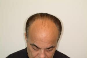 Hair Transplant Before & After | Houston TX