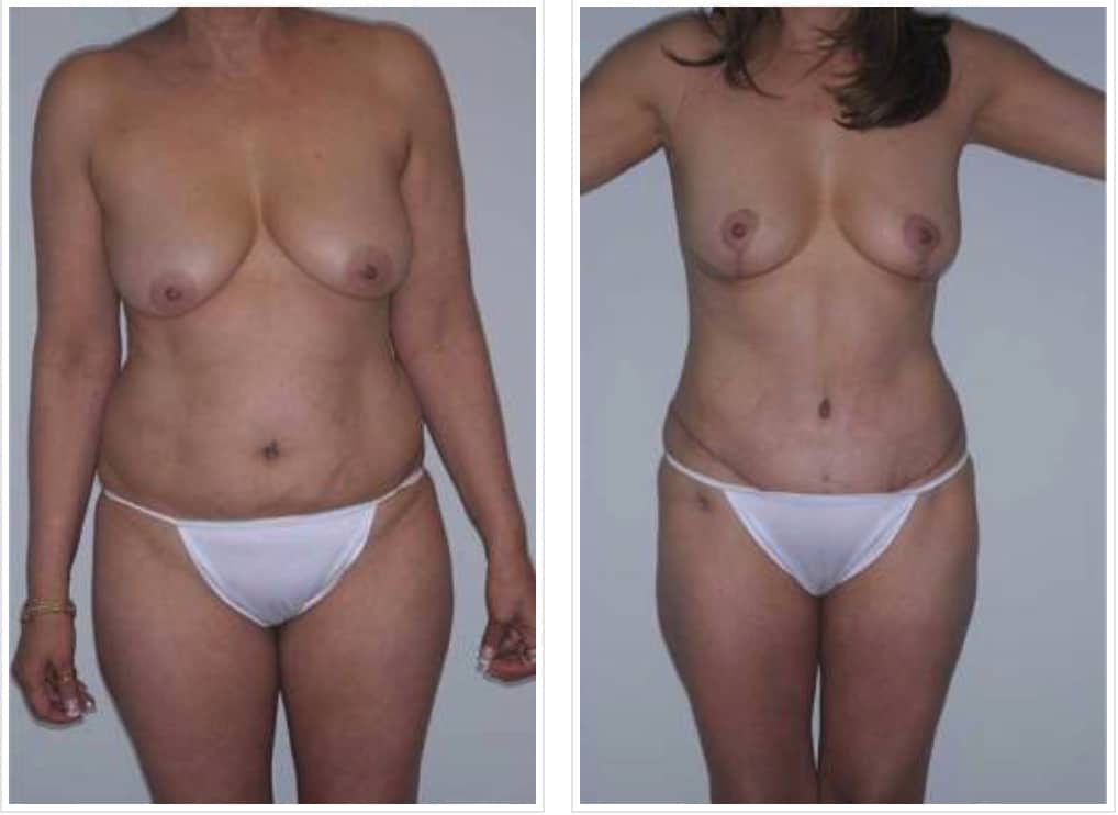 topless woman before and after mommy makeover procedures with flatter stomach afterward