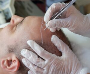 hair transplant procedure in houston texas