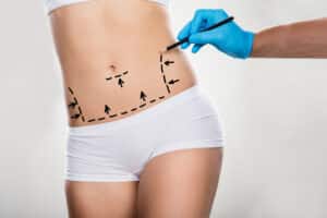 doctor drawing incision lines on patient for Liposuction surgery