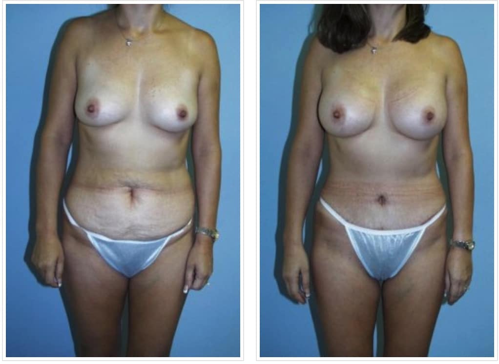 topless woman before and after mommy makeover