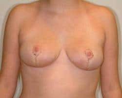 Houston Breast Lift - Mastopexy
