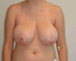Houston Breast Lift - Mastopexy