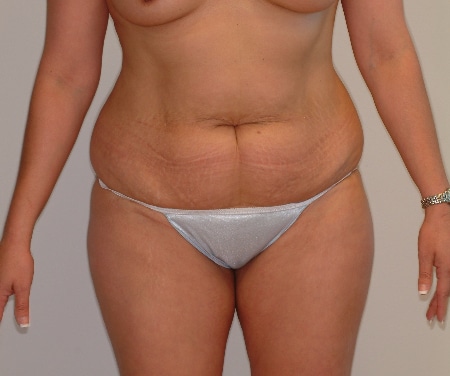 Abdominoplasty - Houston Tummy Tuck
