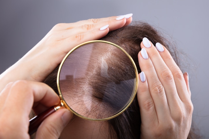 Hair Transplantation in Houston, Texas | Female Pattern Alopecia