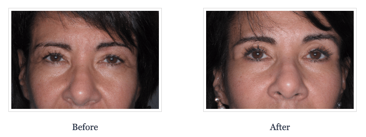 Eyelid Surgery Before & After