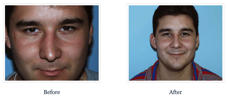 Rhinoplasty Before & After