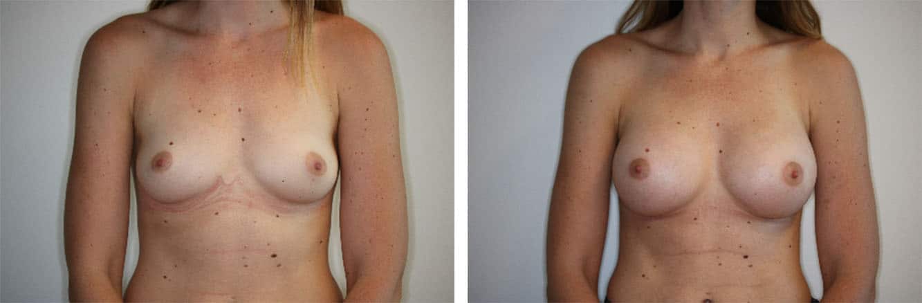 Breast Augmentation Houston, TX