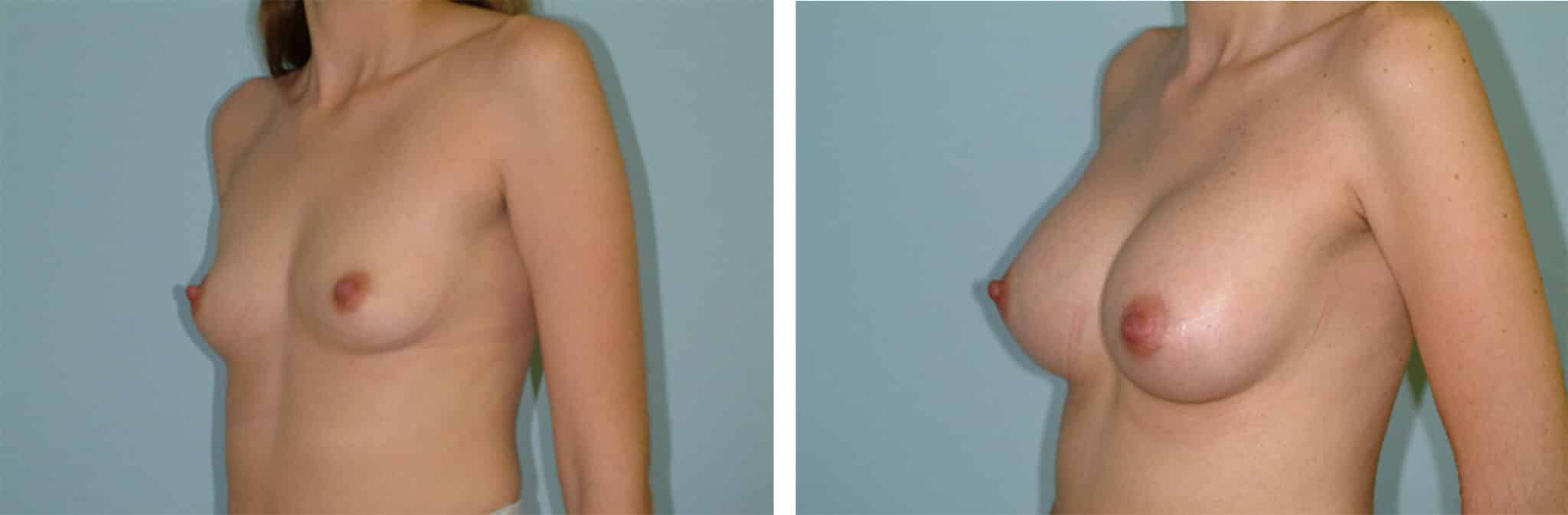 Breast Enhancement Houston, TX