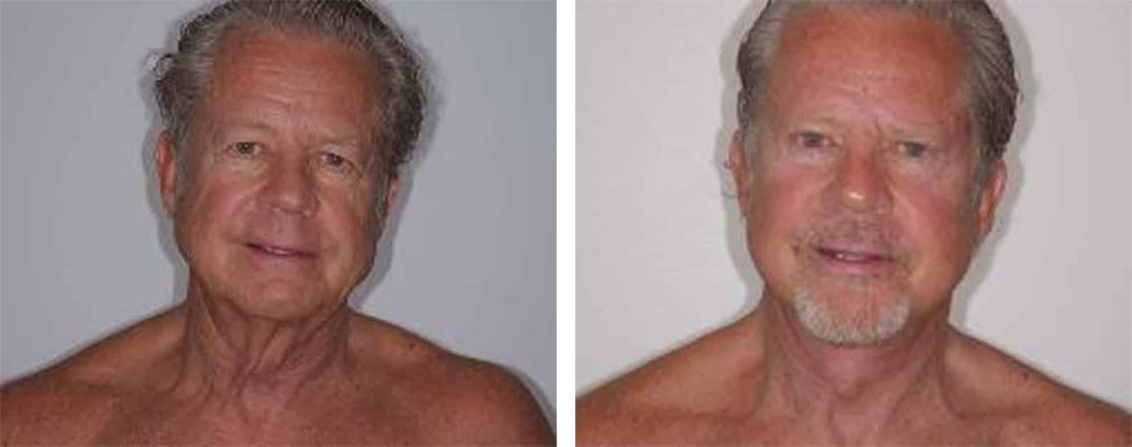 Facelift Surgery Houston, TX