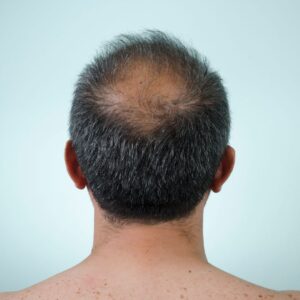 Male Pattern Baldness