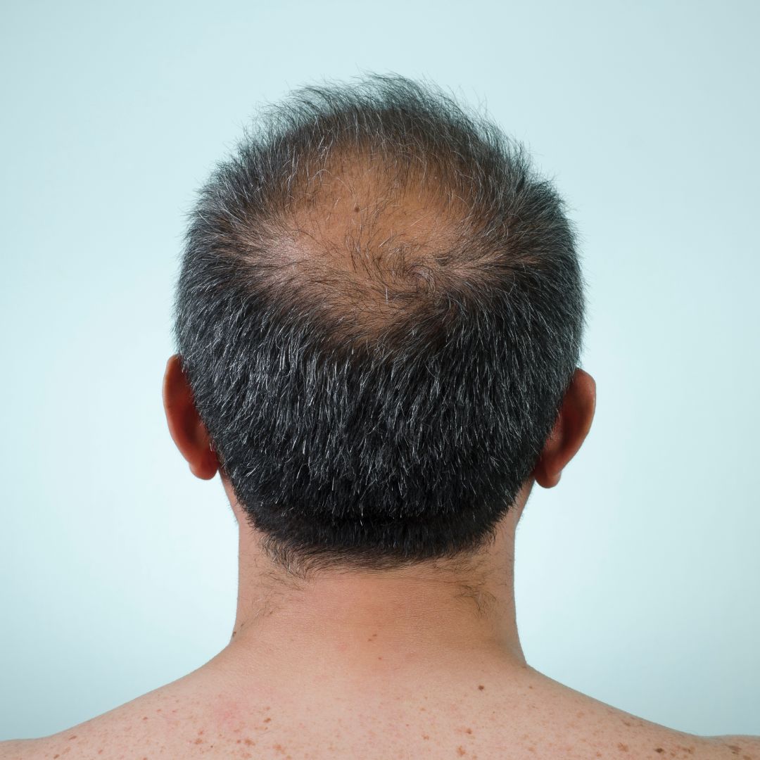 Spring into Normal Hair Growth Where It's Been Thinning! Spring into Normal Hair Growth Where It's Been Thinning!