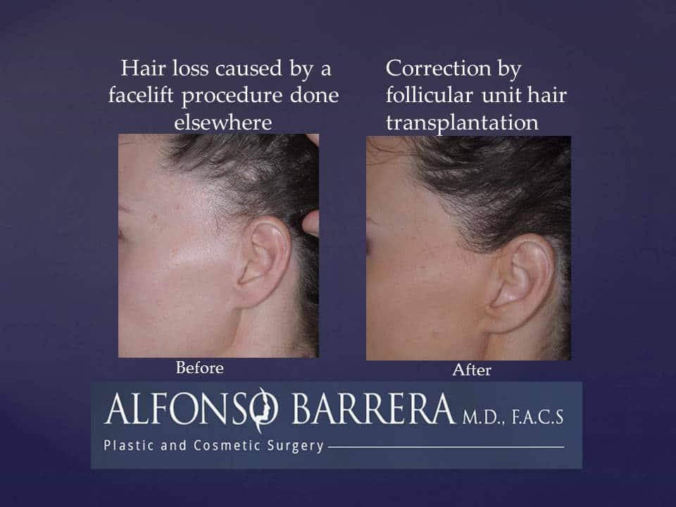 A woman that is experiencing hair loss caused by a facelift procedure done elsewhere. She has underwent a correction by folicular unit hair transplantation. 