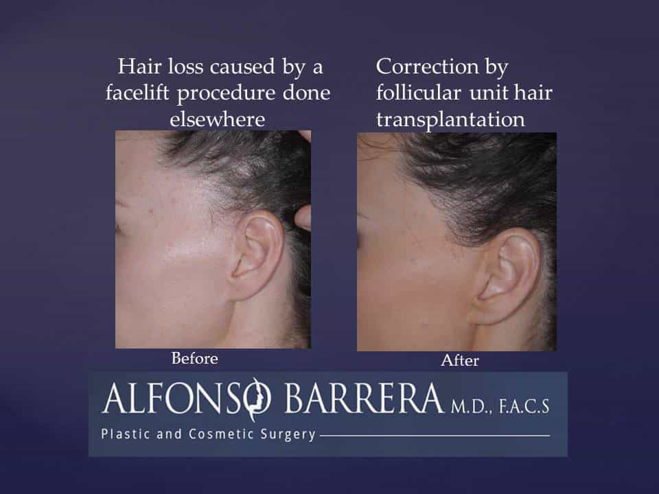 A woman that is experiencing hair loss caused by a facelift procedure done elsewhere. She has underwent a correction by folicular unit hair transplantation. 