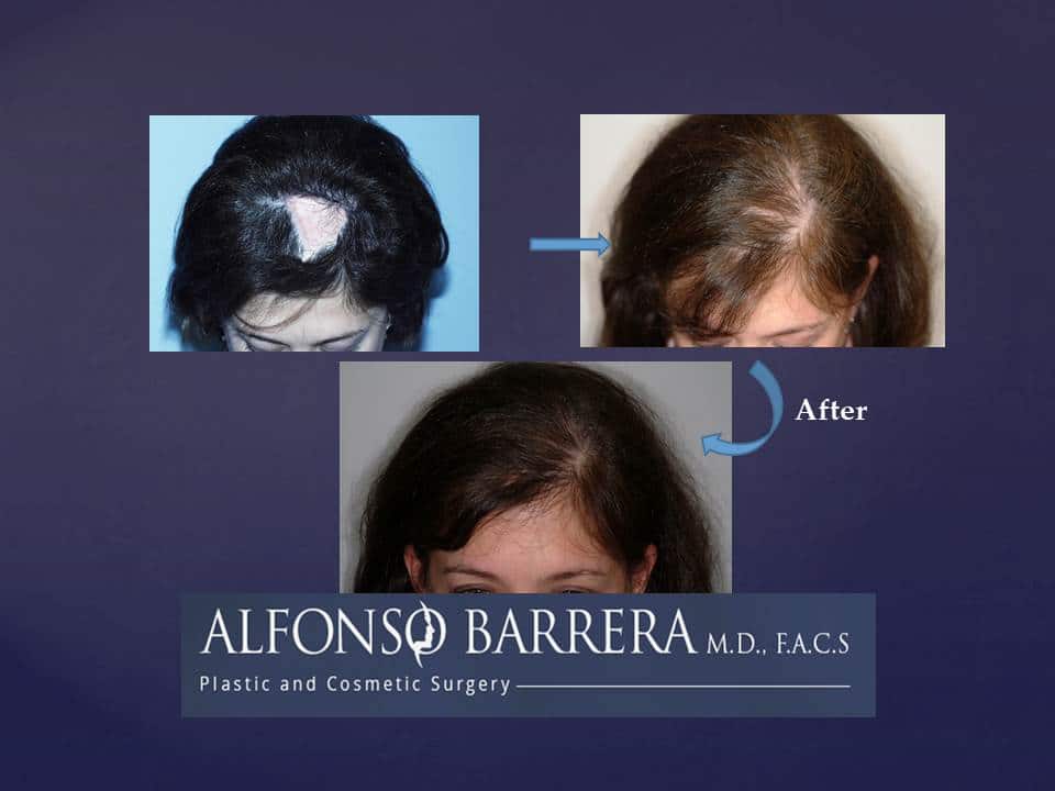 A before and after image collage showing scarring alopecia after an accident. This woman was treated with a reconstructive hair transplantation