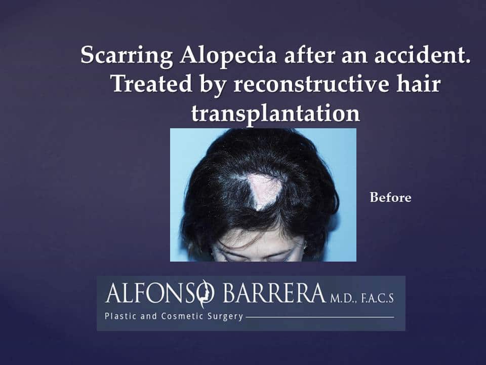 A before image showing scarring alopecia after an accident. This woman was treated with a reconstructive hair transplantation