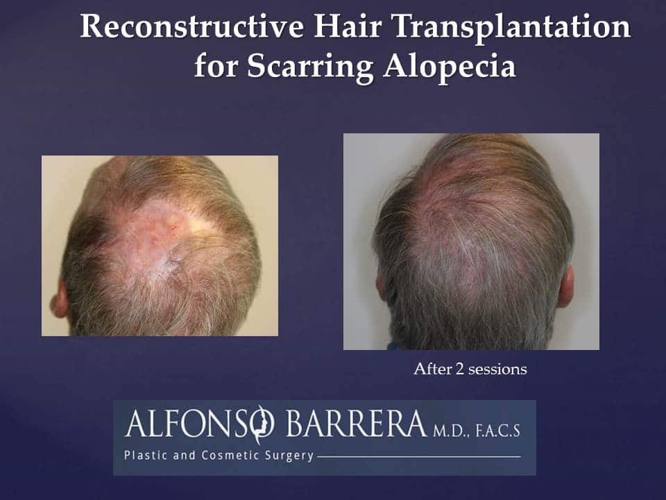 A man that underwent reconstructive hair transplantation for scarring alopecia