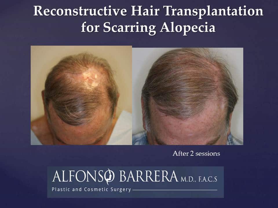 A image of the frontside of a mans head that underwent reconstructive hair transplantation for scarring alopecia