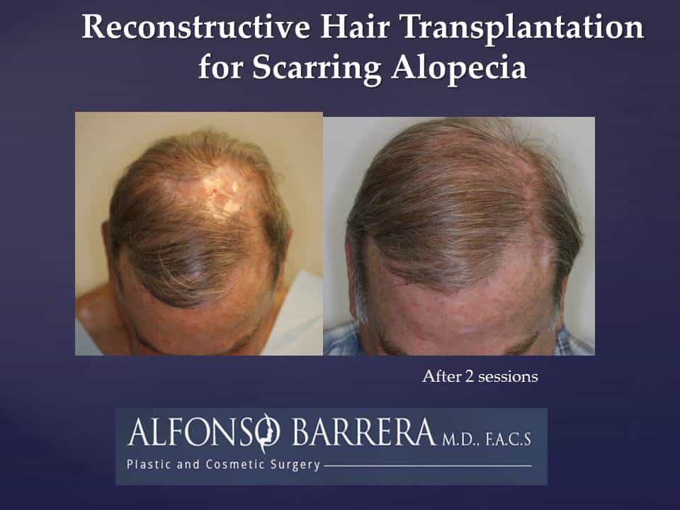 A image of the frontside of a mans head that underwent reconstructive hair transplantation for scarring alopecia