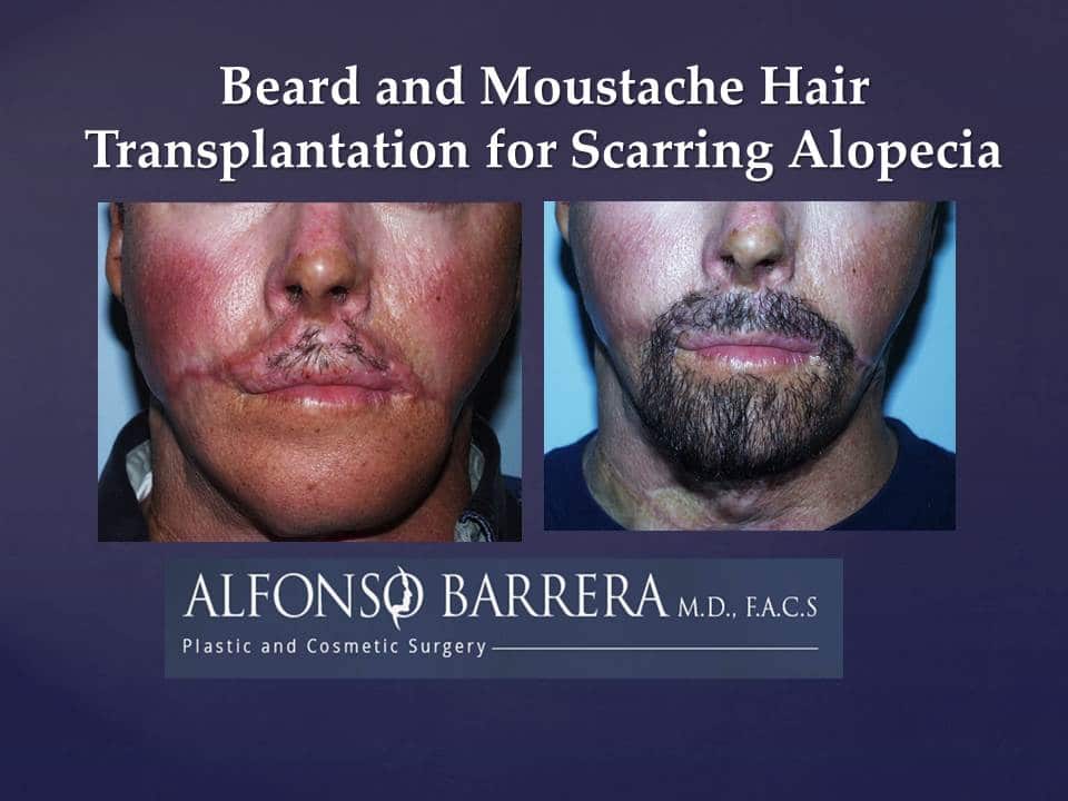 An image of a mans face that underwent a beard and mustache hair transplantation for scarring alopecia