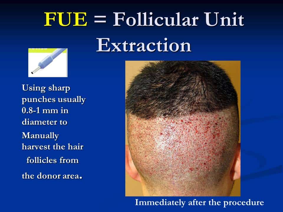 back of male patient’s head before and after follicular unit hair transplantation