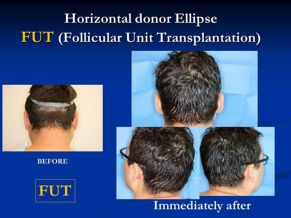 Hair Transplant Houston, TX | Male Pattern Baldness | Alfonso Barrera