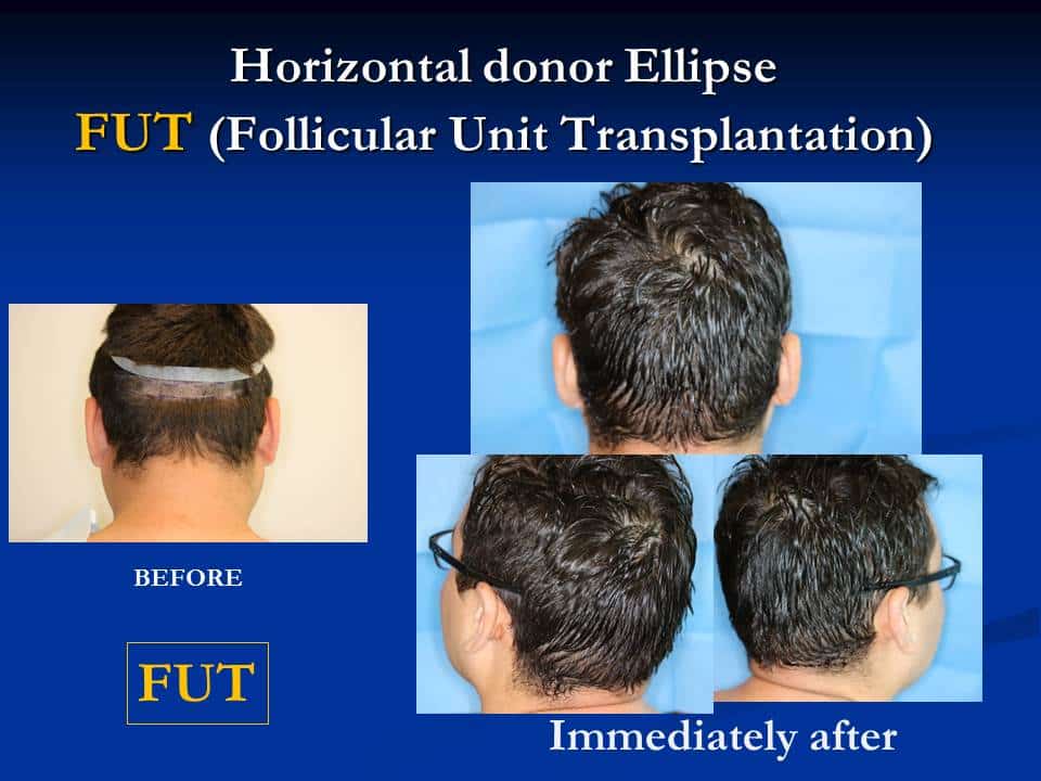 hair transplant houston before and after