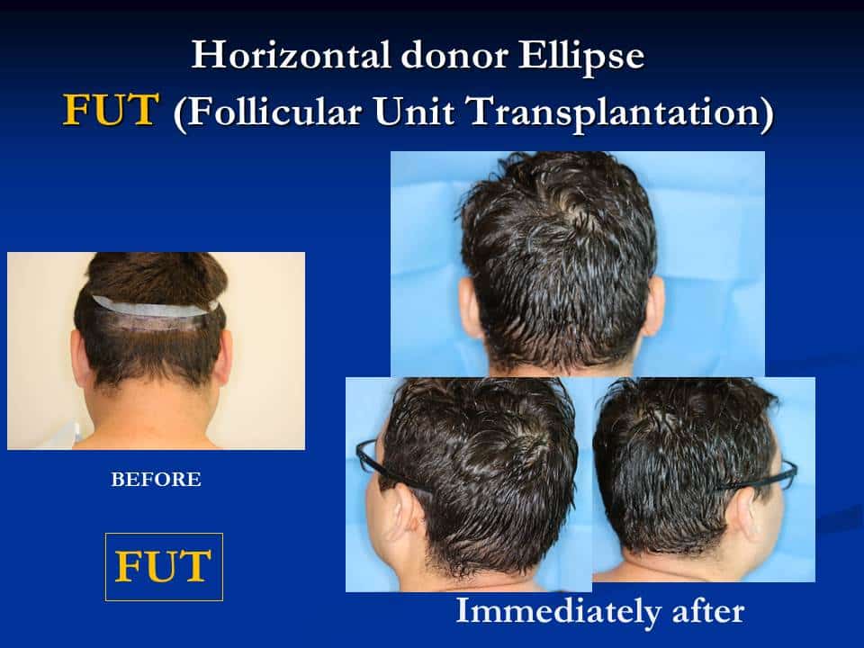 back of male patient’s head before and after follicular unit hair transplantation