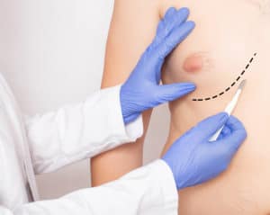 Plastic surgeon tracing the incision mark for a male breast reduction patient